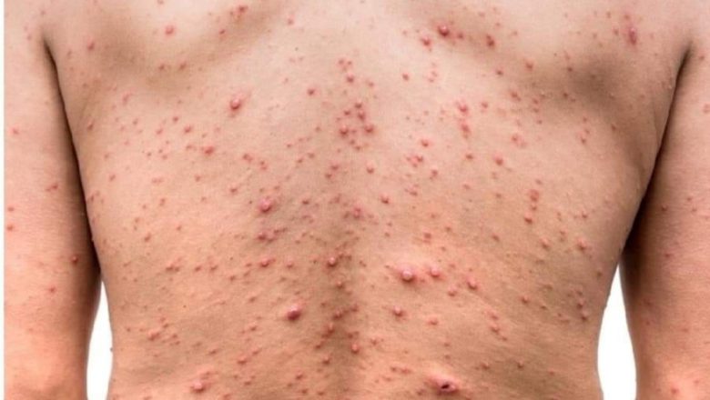 Primer caso de viruela del mono en Bolivia se da en un paciente de 38 años