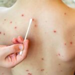 Los contagios de sarampión llegan a 119 en el país