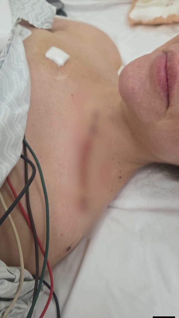 «Que Dios te perdone Cerimedo»: Beller muestra las graves l3s1on3s que le dejó el at3nt4do: una b4la le d3strozó el brazo
