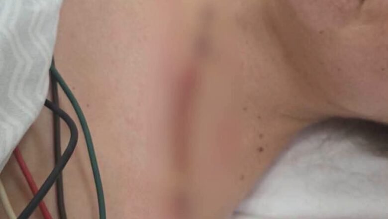 «Que Dios te perdone Cerimedo»: Beller muestra las graves l3s1on3s que le dejó el at3nt4do: una b4la le d3strozó el brazo